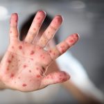 Nicaragua atenta a viruela símica ante declaración de  emergencia sanitaria global