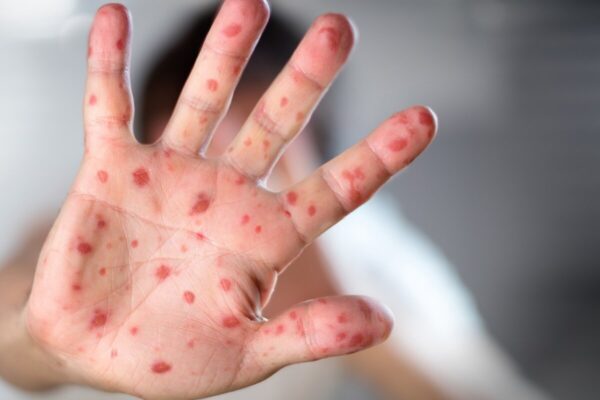 Nicaragua atenta a viruela símica ante declaración de  emergencia sanitaria global