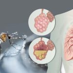 Menos contagios de Neumonía y dengue la última semana en Nicaragua