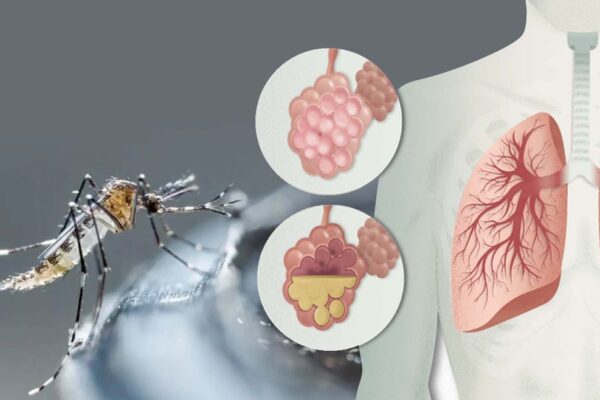 Dengue registra aumento del 21% en casos positivos, mientras que la Neumonía muestra una disminución del 7%.